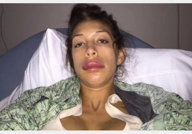 فضائح الفنانات وتعرض عارضة الازياء فرح ابراهام نفخ شفايف بعد عملية التجميل_190362-1420637150