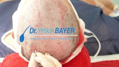 زراعة الشعر في تركيا 2020 ومعلومات افضل المستشفيات التكلفة سعر صور 5